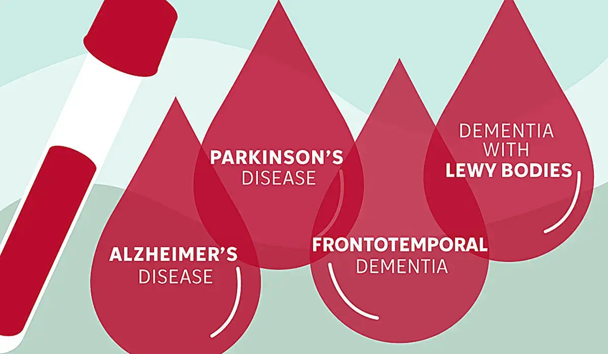 Blood Test with AI Spots Dementia-Related Brain Diseases with High Accuracy